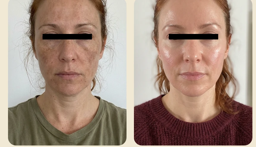 PRX Derm Perfexion™ B&A- d
