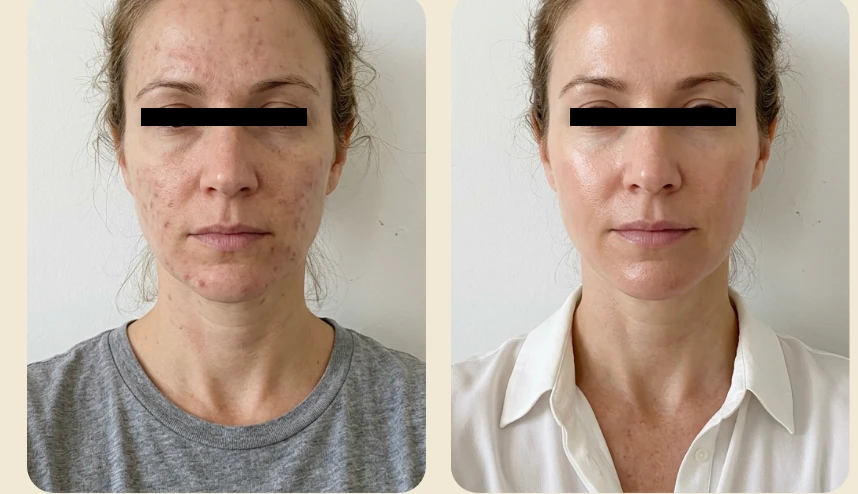 PRX Derm Perfexion™ B&A- e
